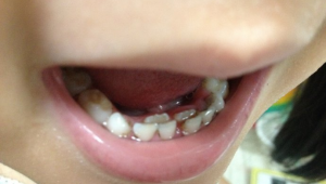 拔完乳牙后能否踢足球?这些要点需知晓