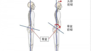 骨盆前倾的男生适合练足球吗