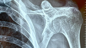 锁骨骨折后还能踢足球吗?康复与运动风险全解析