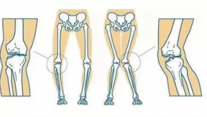 踢足球会影响X型腿吗？带你深入了解其中关联