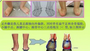 足跟外翻的女生能否踢足球？这份指南请查收