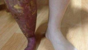 腿烧伤后还能重返绿茵场踢球吗?这背后的真相来了