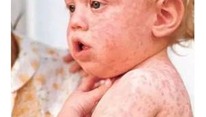 小孩患麻疹期间能否踢足球，这事儿得谨慎对待