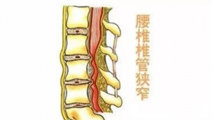 腰椎管狭窄患者能否踢足球？这些要点需知晓