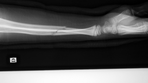 手臂骨折后能踢足球吗