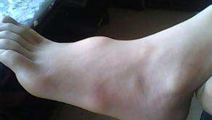 脚背囊肿患者能否踢足球？这些要点需知晓