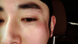 被足球踢到头会出现凹陷吗