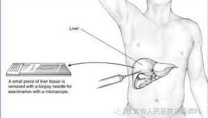 肝穿刺后踢足球有无影响，你想知道的答案都在这里！