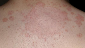 玫瑰糠疹期间能否踢足球？这些要点需知晓