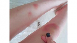 被足球砸青了能恢复吗?了解恢复方法与时间,让淤青快速消散