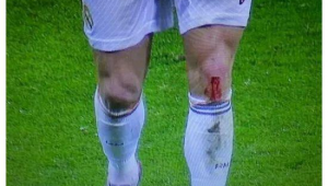 足球钉鞋容易受伤吗?深度剖析钉鞋与运动损伤的关联