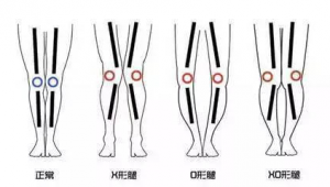 女生踢足球腿会变形吗?真相来了!