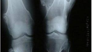 膝盖软骨瘤患者能踢足球吗?这份指南请查收!