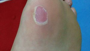 脚底破皮能否踢足球？风险与考量需谨慎对待